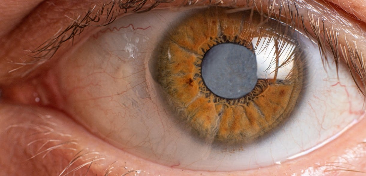 Exploring Cataracts: Symptoms, Causes, and Treatment Methods - Amazing Eye Care Atascocita