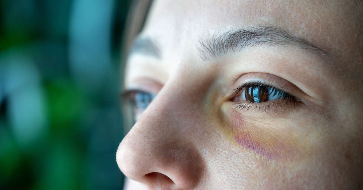 what causes bruising in the eye