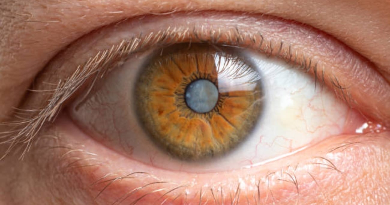 how to slow cataract progression tips for eye health and wellness in atascocita