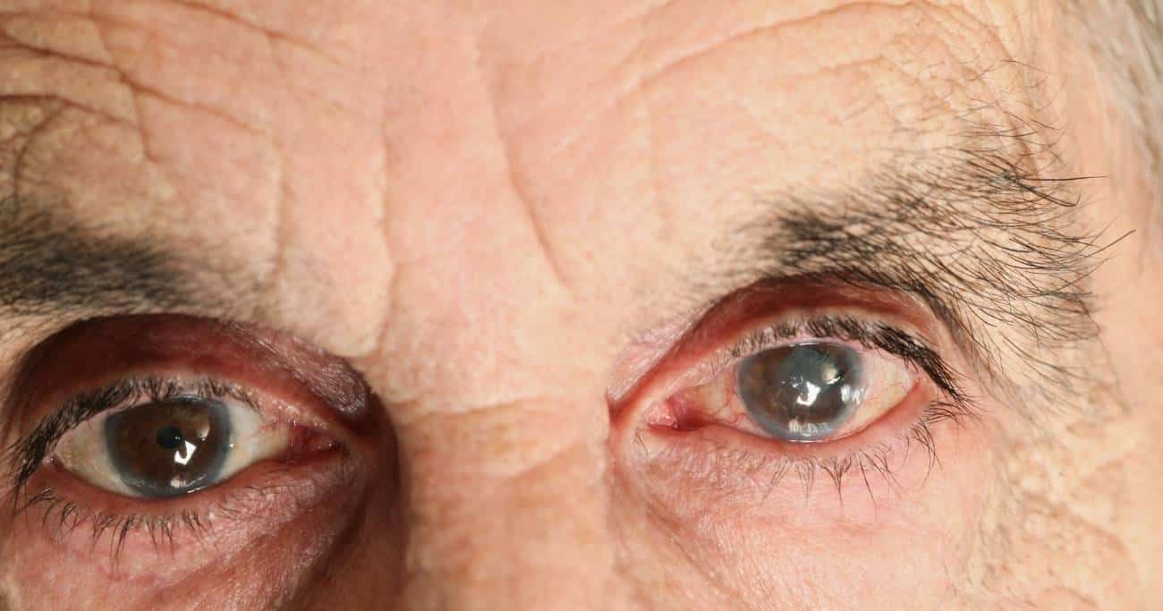 long-term care after cataract surgery